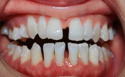牙齿稀疏矫正容易吗？