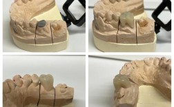 增加桩核固位的方法中
