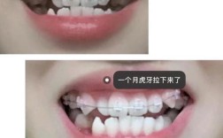 杭州虎牙矫正有哪些方法？如何选择适合自己的矫正方式？