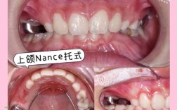 滑动法关闭正畸间隙