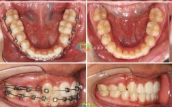 正畸拔了不对称的牙