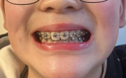 正畸三个月露牙龈