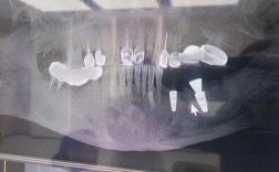 种牙不拍CBCT可行吗？存在哪些风险？