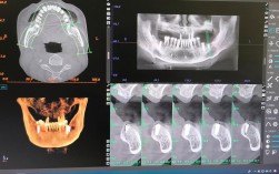 种牙怎么做ct