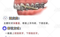 牙科正畸牵引圈的具体用法是什么？不同牙齿错颌畸形如何选择牵引方式？操作步骤和常见误区有哪些？