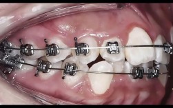 大学矫正牙齿，会不会影响学业和生活？