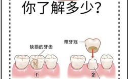 冠牙炎有哪些治疗方法？不同严重程度下如何选择治疗方式？日常护理对治疗效果有何影响？