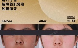 骨突正畸完美病例，效果真的无可挑剔吗？