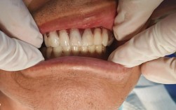 正畸术前模型取咬合蜡，对矫正效果有何关键作用？