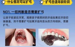 矫正牙齿扩弓的利弊