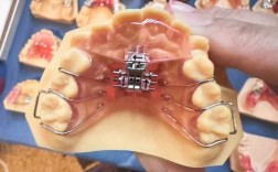 牙齿早期矫正套适合哪些孩子？矫正效果如何？