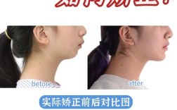 牙齿矫正会让下巴变长吗？