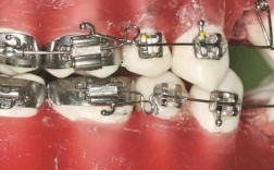 正畸理想弓弯制图片