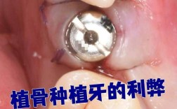 几岁牙植骨