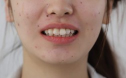 正畸III类倾向均角患者的矫治策略如何制定？