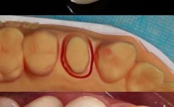 全瓷义齿内冠染色方法如何实现自然美观与持久效果？