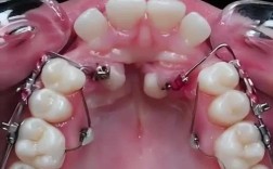 正畸牵引钩与颊面管的应用要点及协同方法有哪些？