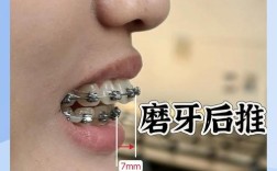 矫正牙齿戴推簧好疼，是正常现象吗？咋缓解呀？