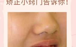 牙齿外凸能正畸吗