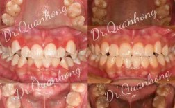 广州快速牙齿矫正效果真的快吗？靠谱吗？