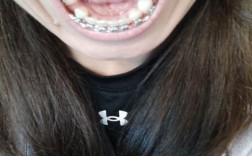 正畸牙齿拔牙一颗