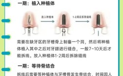 种牙到底算不算大手术？其手术风险、操作复杂度和恢复周期究竟如何？