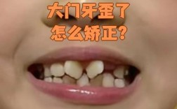 正畸后牙齿为何会斜？是矫正失败还是正常反弹？