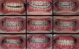 正畸全同步带状弓