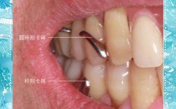正畸带环摘下来