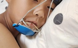 地中海贫血患者牙齿畸形矫正有哪些特殊考量？