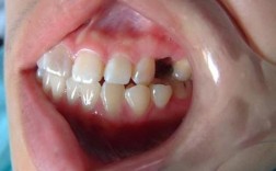 种牙后牙槽骨萎缩为何发生？原因与应对方法