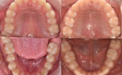 第二尖牙拔除后正畸