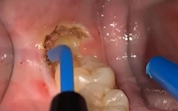 矫正牙齿期间拔智齿