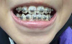 正畸复查延迟一个月，原因及影响如何？