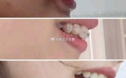 牙齿矫正会导致牙槽骨增生吗？原因和应对方法是什么？