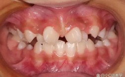 矫正牙齿的危害青少年