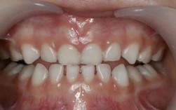 儿童正畸后牙齿变色是什么原因导致的？会影响牙齿健康吗？该如何有效处理和预防？