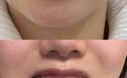 矫正牙齿期间牙缝变大是正常现象吗？