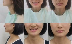 牙齿矫正下巴前后对比，差异明显吗？