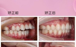 牙齿矫正内收是什么？内收矫正是指牙齿向内移动的过程吗？