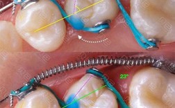 正畸戴弹簧的内收效果真的有效吗？