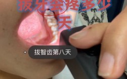 矫正拔牙后疼痛一般持续几天？