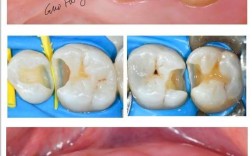 树脂牙齿抛光最简单方法