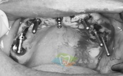 即刻负重植牙手术是什么？有何优势？