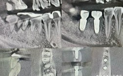 种牙材料会影响核磁共振检查吗？