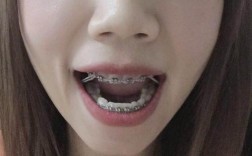 30岁矫正牙齿还来得及吗？会不会太晚效果打折扣？