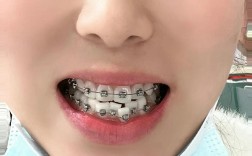 22岁牙齿矫正拔牙是必须的吗？拔牙风险和效果如何？