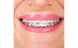 如何正确摘戴保持器？步骤和注意事项有哪些？