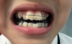 用弓丝扩弓正畸