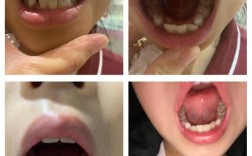 小s女儿矫正牙齿